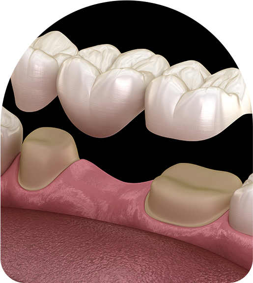 Dental Bridges Dromana