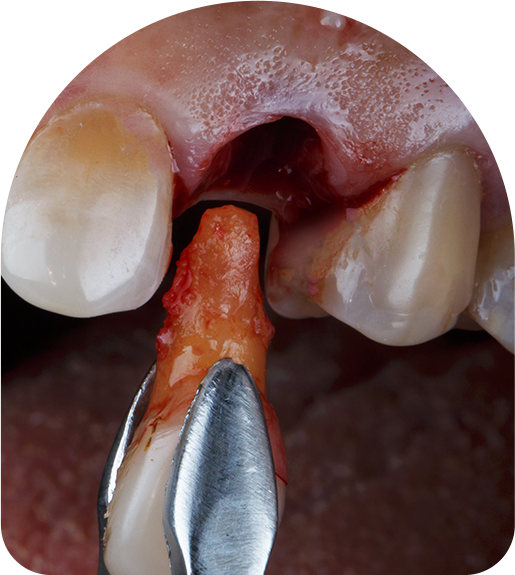Dromana Tooth Removal